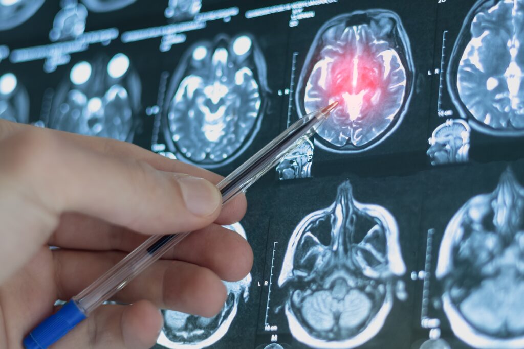 Impact of Brain Trauma